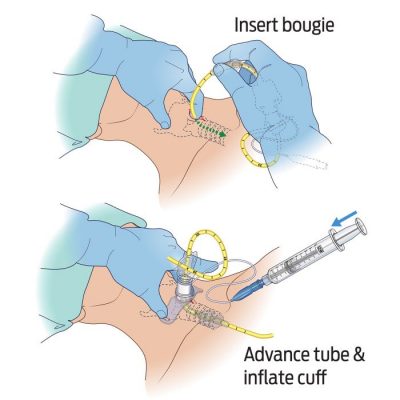 BAC-PACK - BOUGIE AIDED CRICOTHYROIDOTOMY PACK